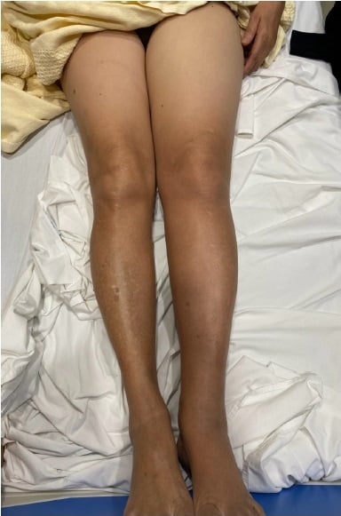 If neglected, discolouration in the legs can develop.