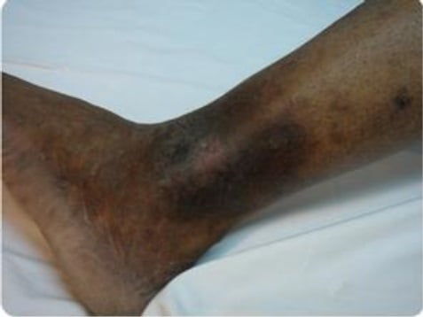 In the more severe cases of long-term neglect, ulcers will form and permanently damage the skin.