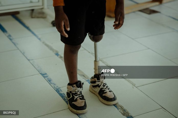 DR Congo's amputees bear scars of years of conflict