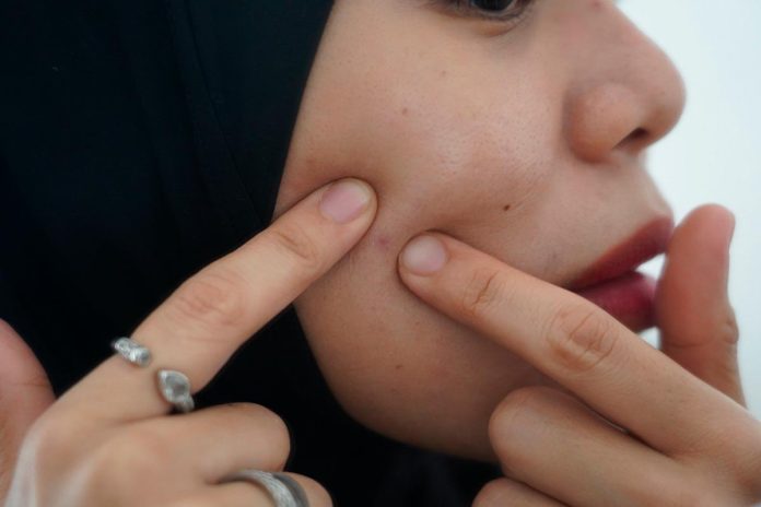 Holistic approach key to appropriate acne care Holistic approach key to appropriate acne care