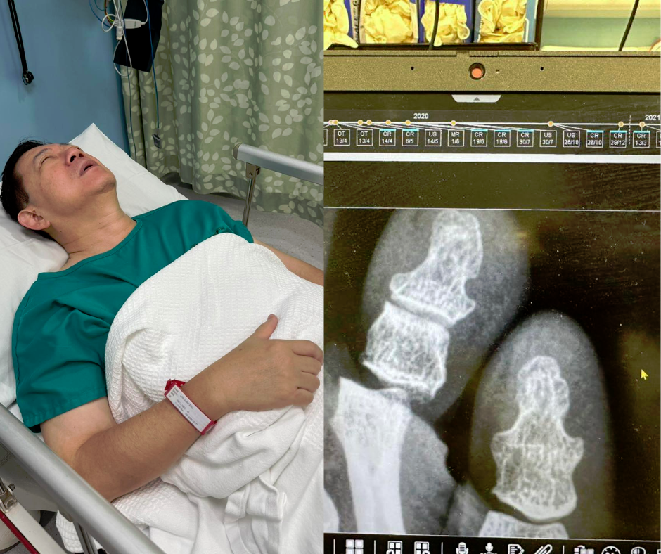 Lim Guan Eng dislocates toe after hitting it against bed corner – netizens feel the pain Lim Guan Eng dislocates toe after hitting it against bed corner – netizens feel the pain