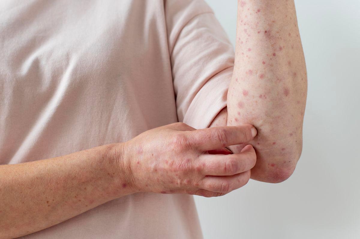 Measles outbreak in West Texas declared over by health officials Measles outbreak in West Texas declared over by health officials