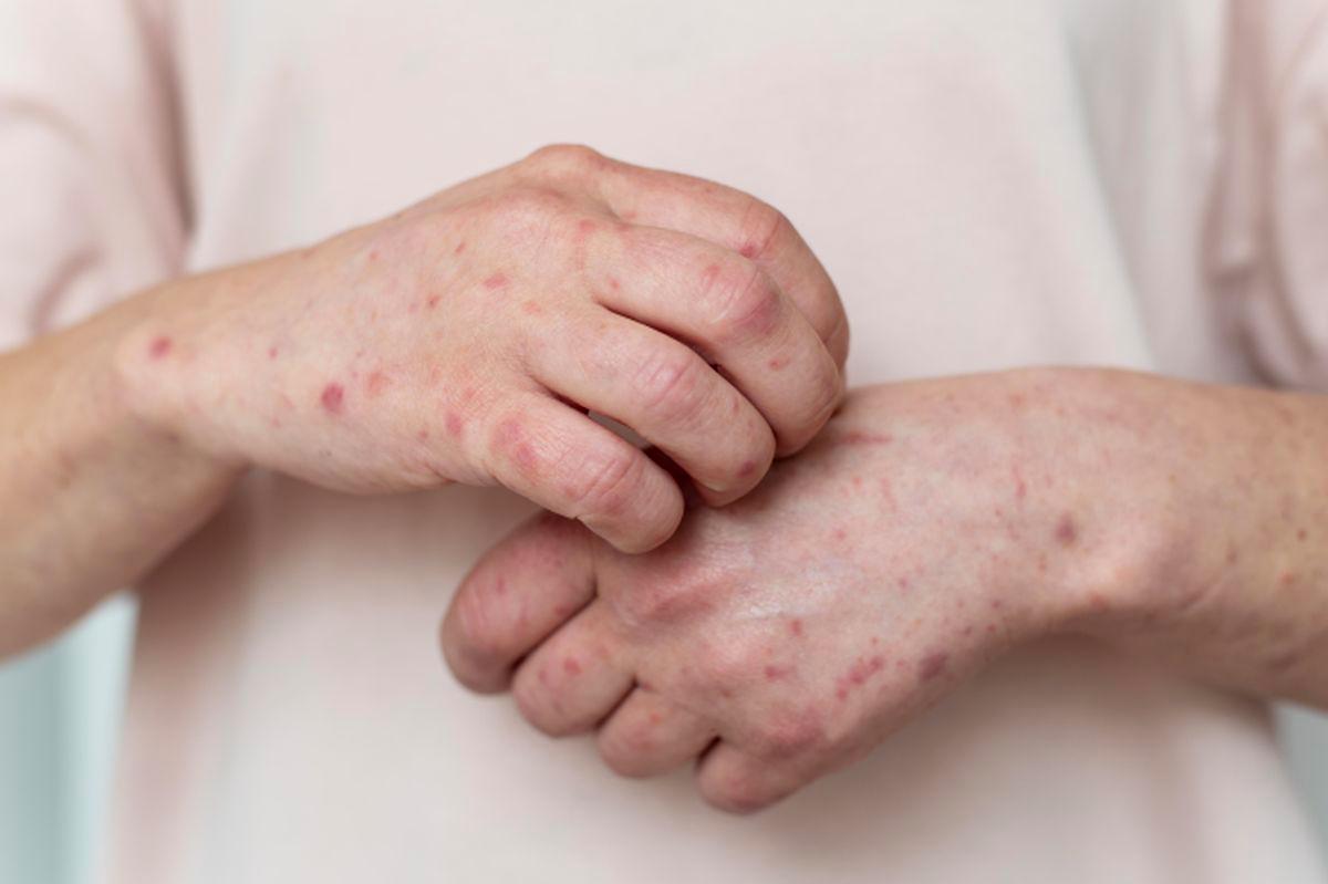 Week 17 shows 99,601 hand, foot and mouth disease cases reported nationwide - KKM Week 17 shows 99,601 hand, foot and mouth disease cases reported nationwide - KKM