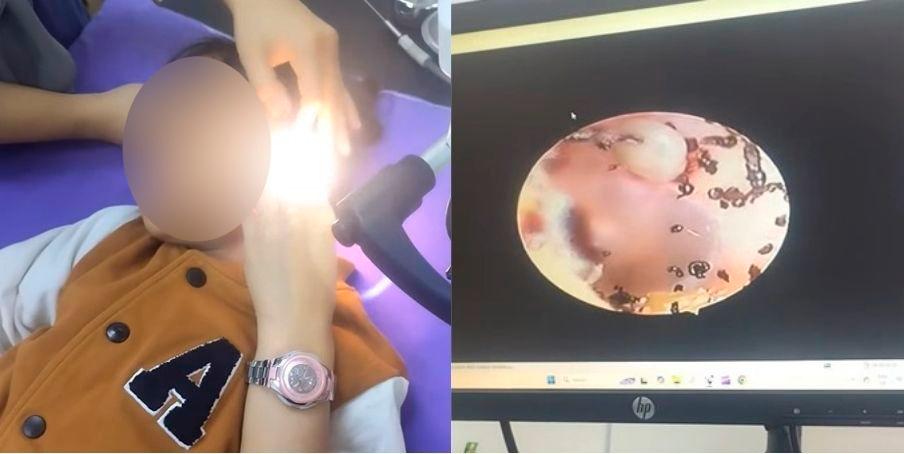 Woman in Melaka discovers ticks in young daughter’s ear following complaints of ear pain Woman in Melaka discovers ticks in young daughter’s ear following complaints of ear pain