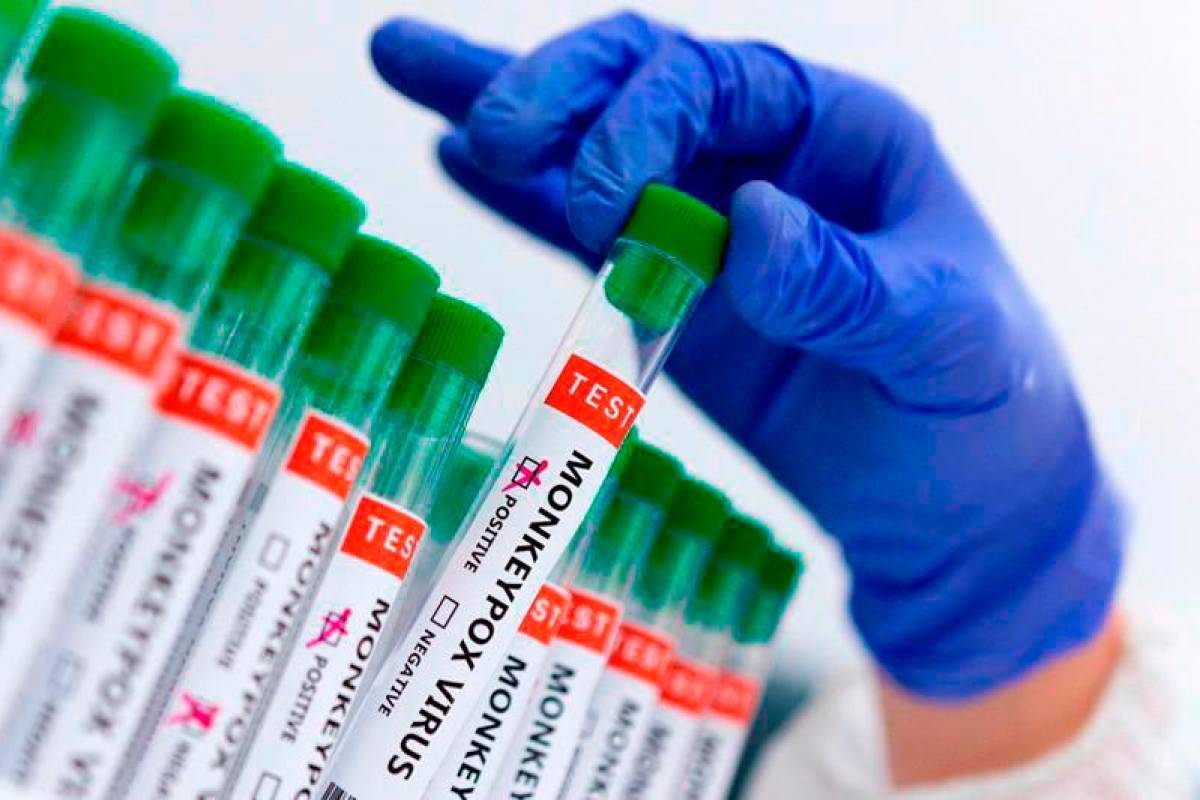 India ‘investigating’ suspected mpox case India ‘investigating’ suspected mpox case