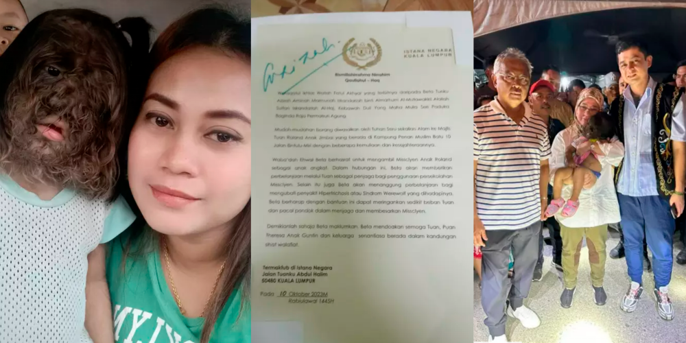 Queen ‘adopts’ Sarawakian girl with rare Werewolf Syndrome Queen ‘adopts’ Sarawakian girl with rare Werewolf Syndrome
