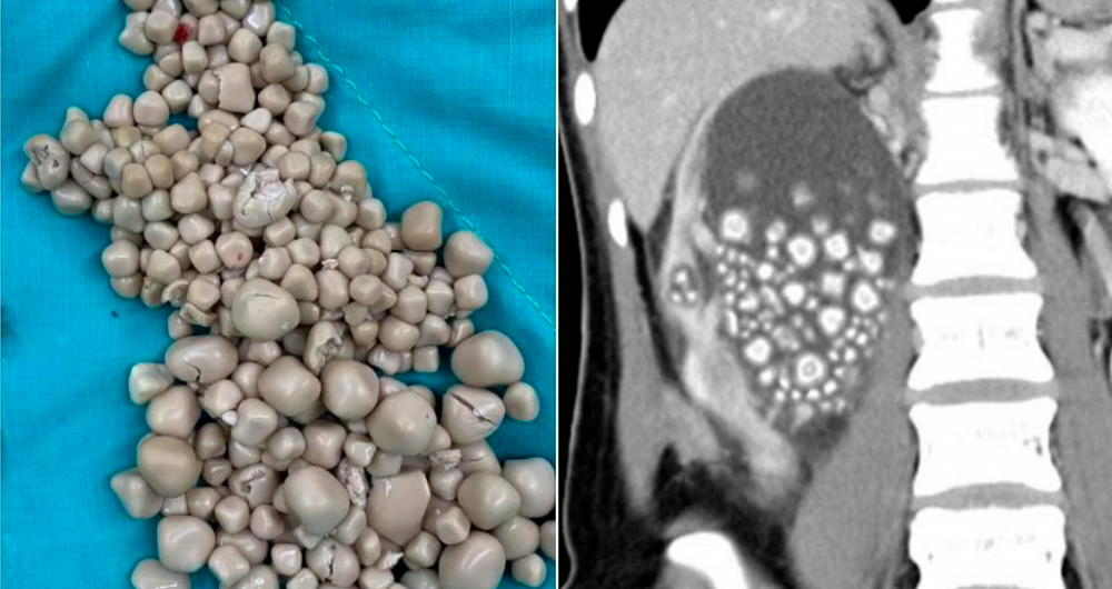 Taiwanese woman had surgery to remove 300 kidney stones due to her addiction to bubble tea