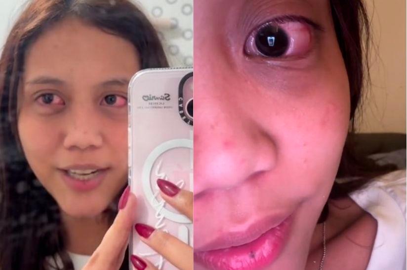 Woman contracts eye infection after purchasing contact lenses via TikTok Woman contracts eye infection after purchasing contact lenses via TikTok