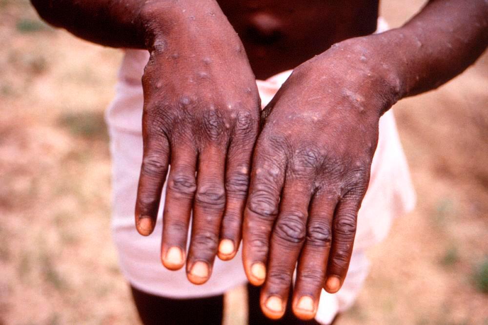 Thailand reports first monkeypox case in a woman Thailand reports first monkeypox case in a woman