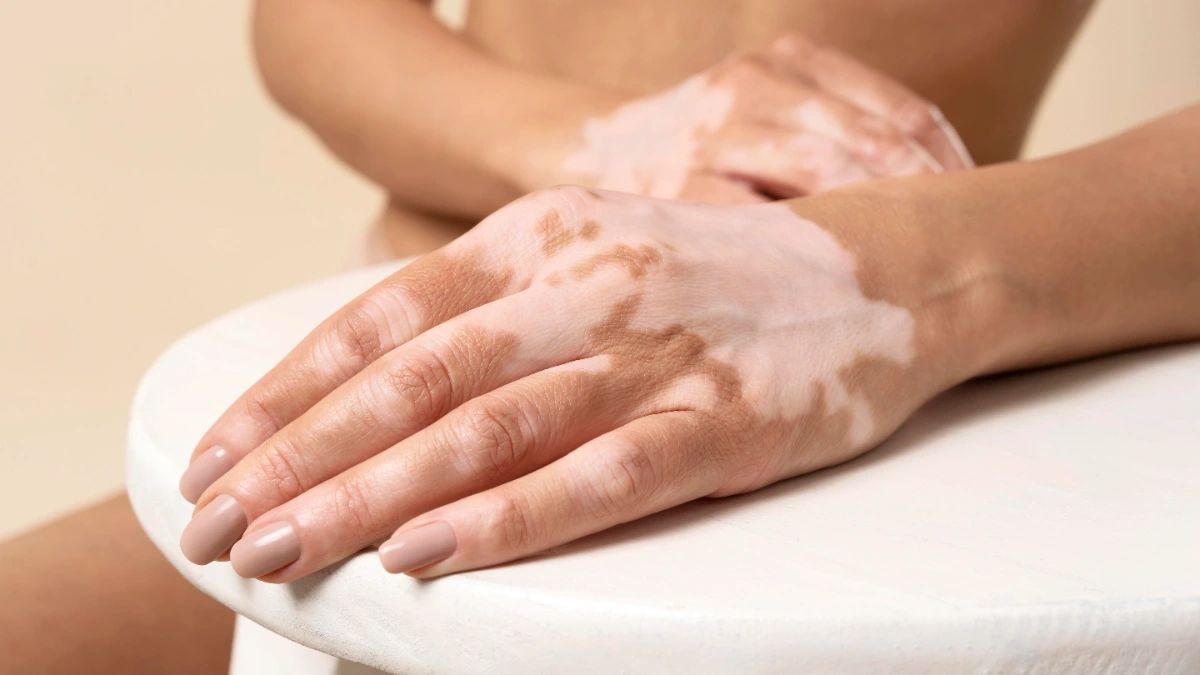 Vitiligo: Beyond the white patches